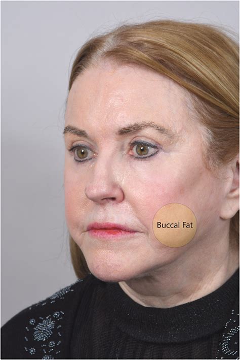 Managing the Buccal Fat Pad .